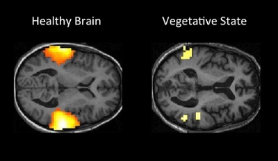 coma patients brain activity